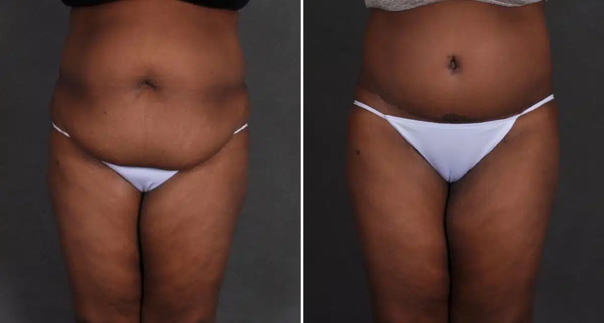 Liposuction Before and After Photos in Omaha, NE, Case 9886