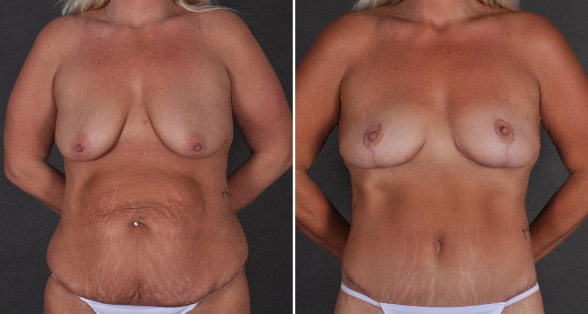 Liposuction Before and After Photos in Omaha, NE, Case 9924