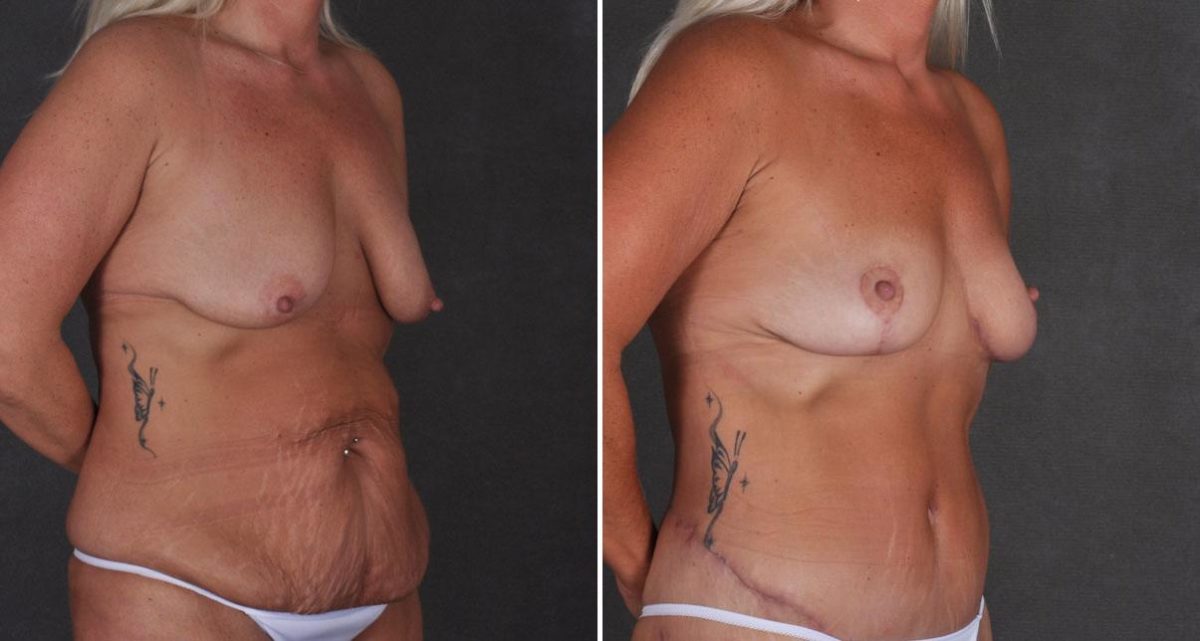 Liposuction Before and After Photos in Omaha, NE, Case 9924