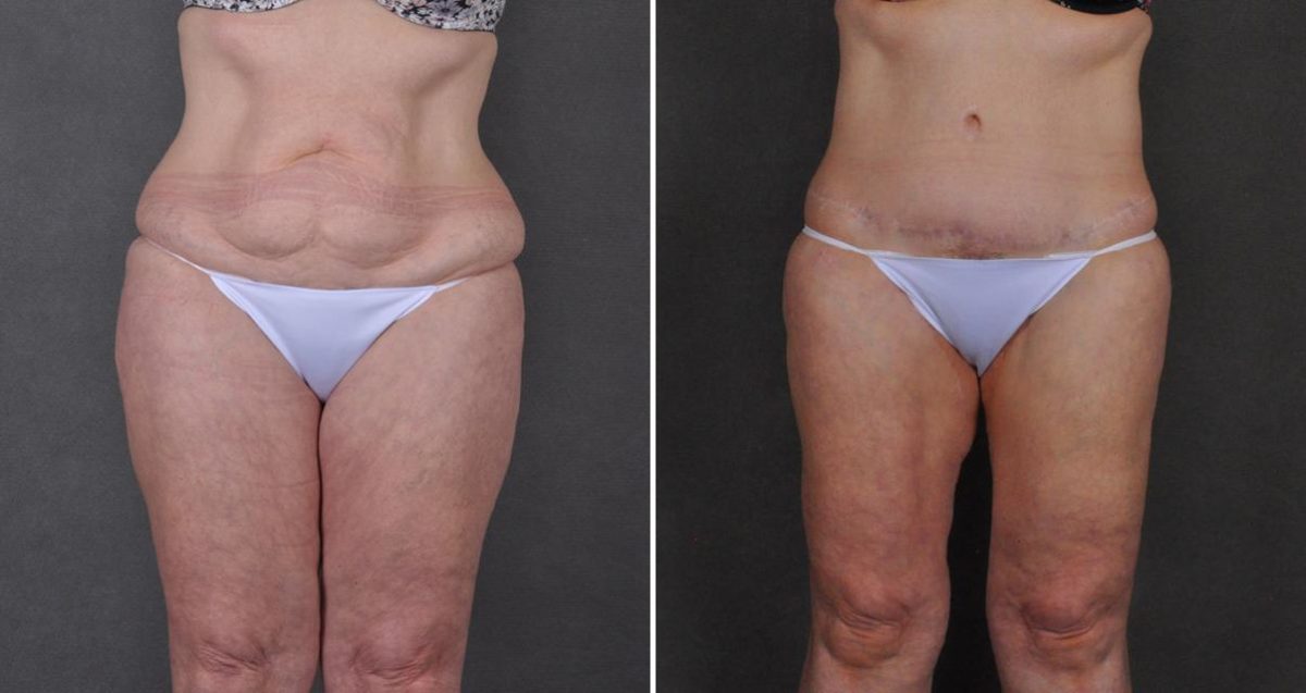 Liposuction Before and After Photos in Omaha, NE, Case 10366