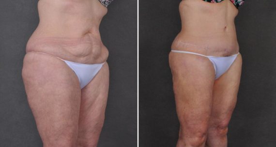 Liposuction Before and After Photos in Omaha, NE, Case 10366