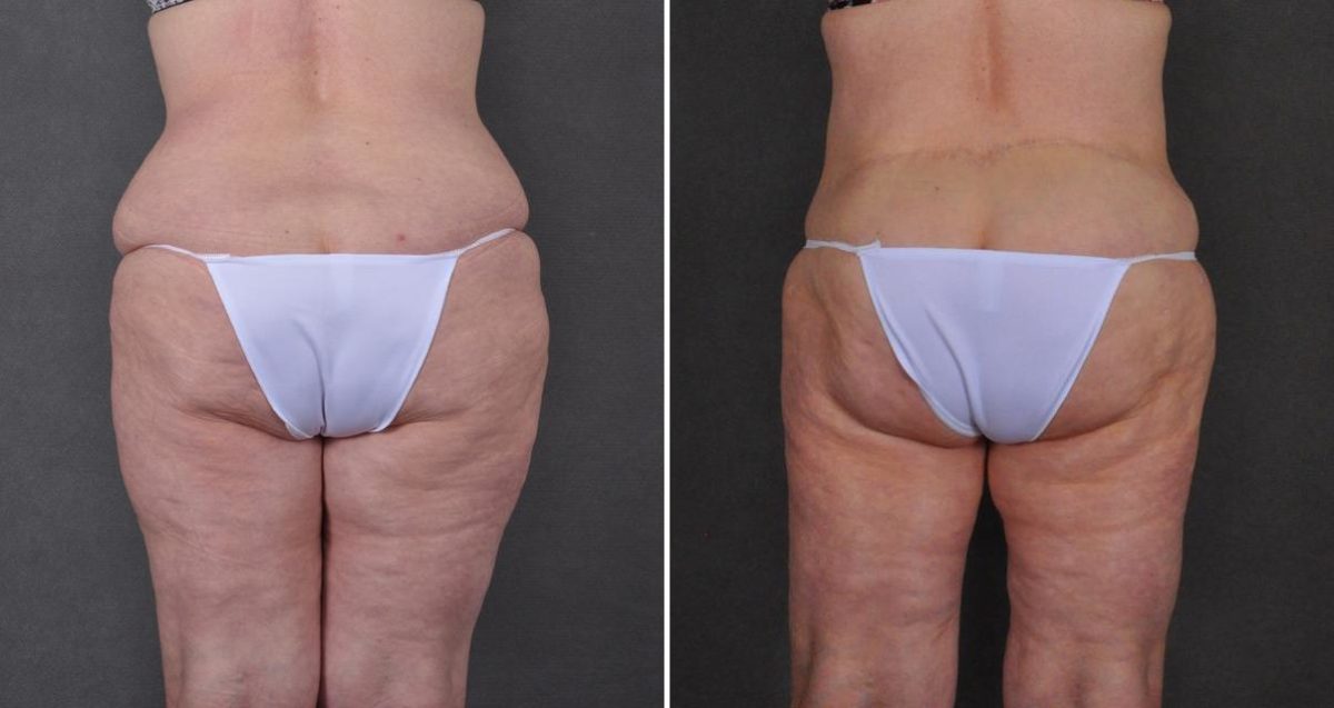 Liposuction Before and After Photos in Omaha, NE, Case 10366