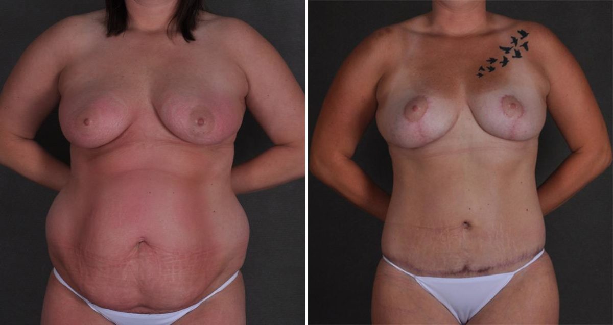 Liposuction Before and After Photos in Omaha, NE, Case 10382