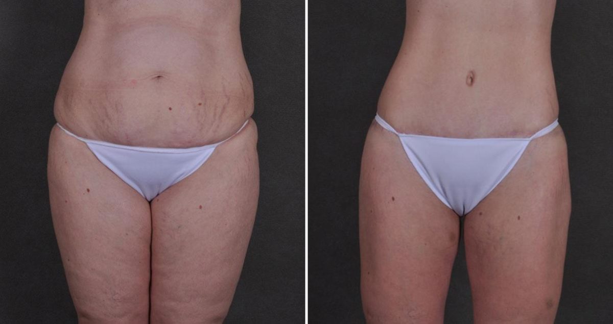 Liposuction Before and After Photos in Omaha, NE, Case 9896