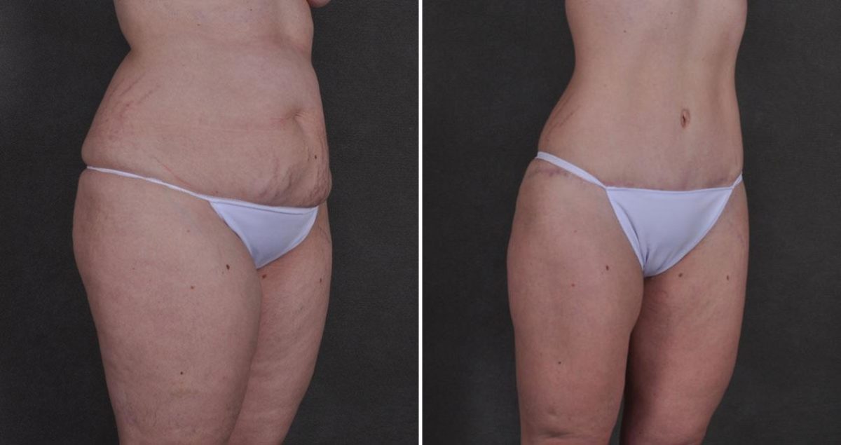 Liposuction Before and After Photos in Omaha, NE, Case 9896