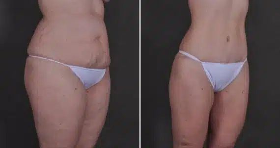 Liposuction Before and After Photos in Omaha, NE, Case 9896