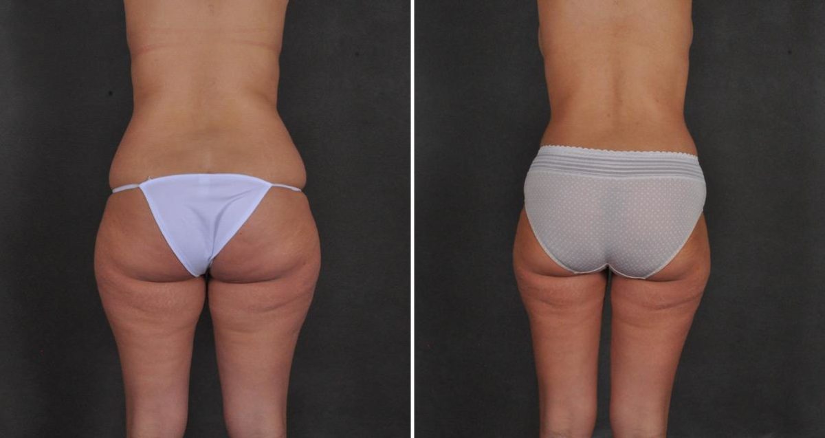 Liposuction Before and After Photos in Omaha, NE, Case 10400