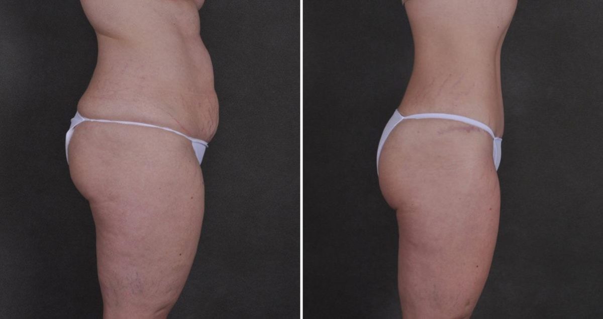 Liposuction Before and After Photos in Omaha, NE, Case 9896