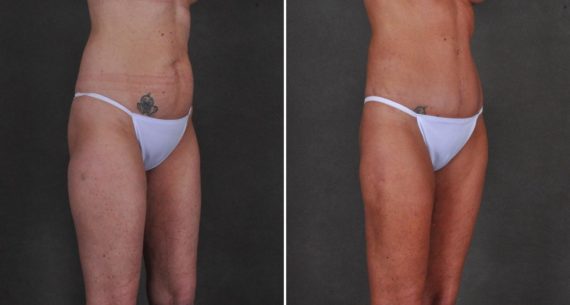 Liposuction Before and After Photos in Omaha, NE, Case 10416