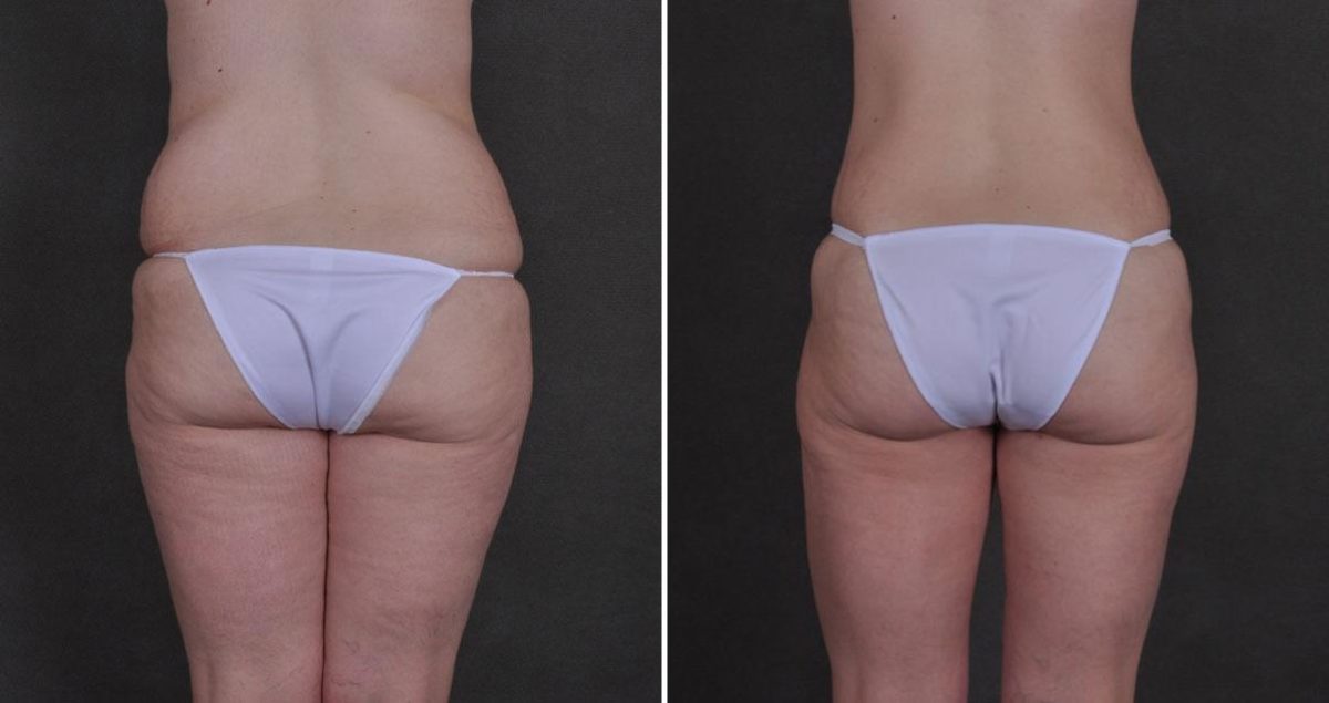 Liposuction Before and After Photos in Omaha, NE, Case 9896