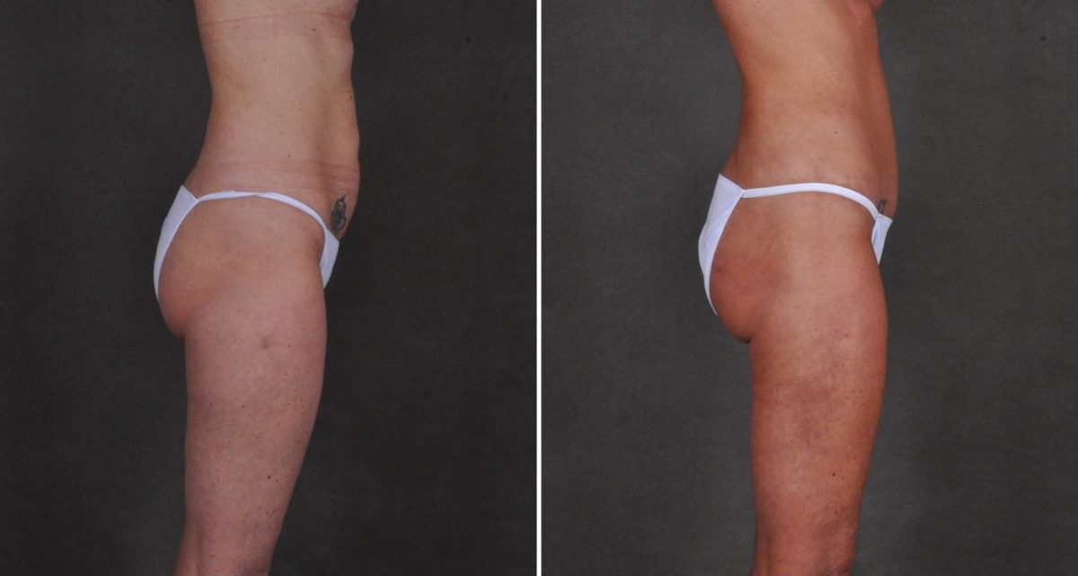 Liposuction Before and After Photos in Omaha, NE, Case 10416