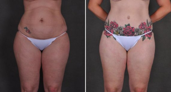 Liposuction Before and After Photos in Omaha, NE, Case 10433