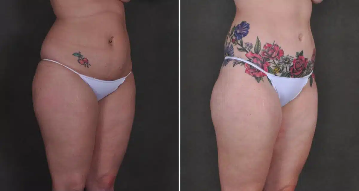 Liposuction Before and After Photos in Omaha, NE, Case 10433