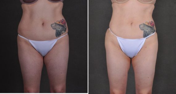 Liposuction Before and After Photos in Omaha, NE, Case 10458