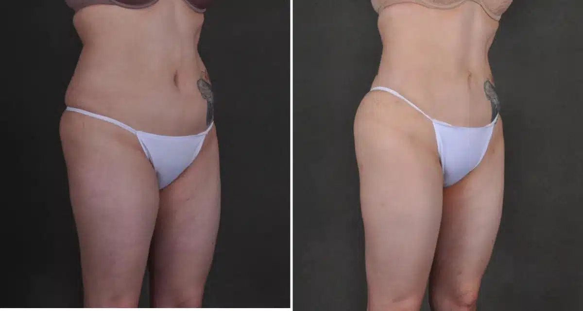 Liposuction Before and After Photos in Omaha, NE, Case 10458