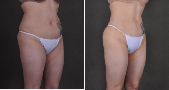 Liposuction Before and After Photos in Omaha, NE, Case 10458