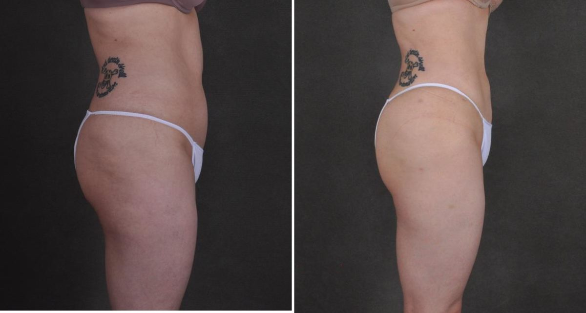 Liposuction Before and After Photos in Omaha, NE, Case 10458