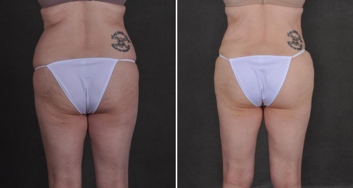 Liposuction Before and After Photos in Omaha, NE, Case 10458