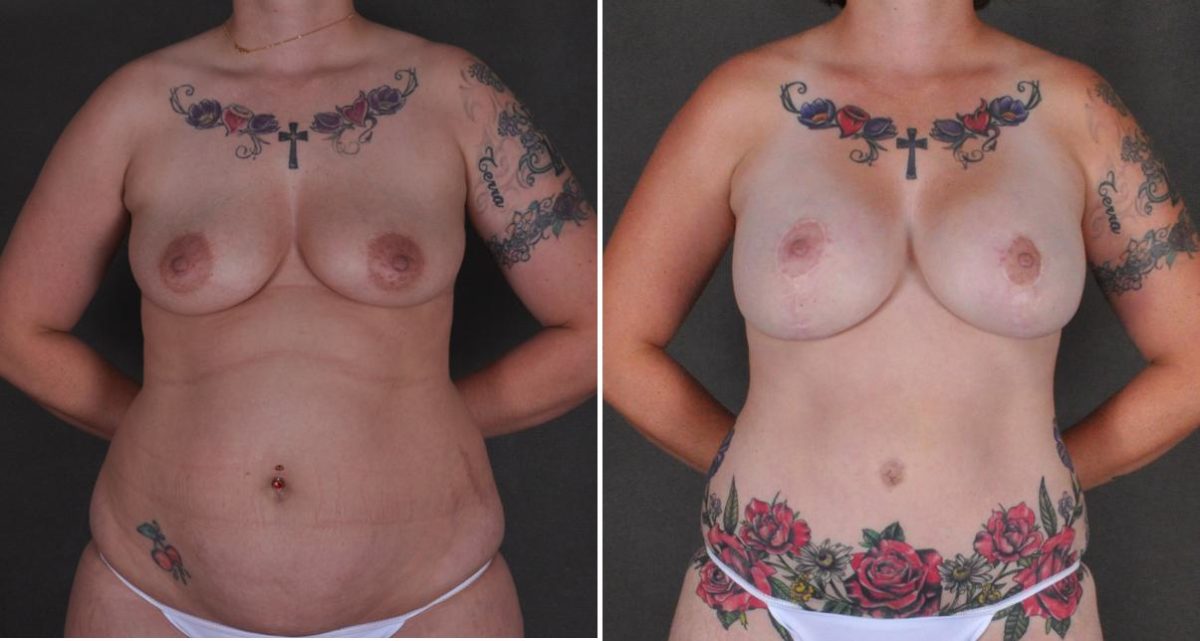 Breast Lift Before and After Photos in Omaha, NE, Case 10456