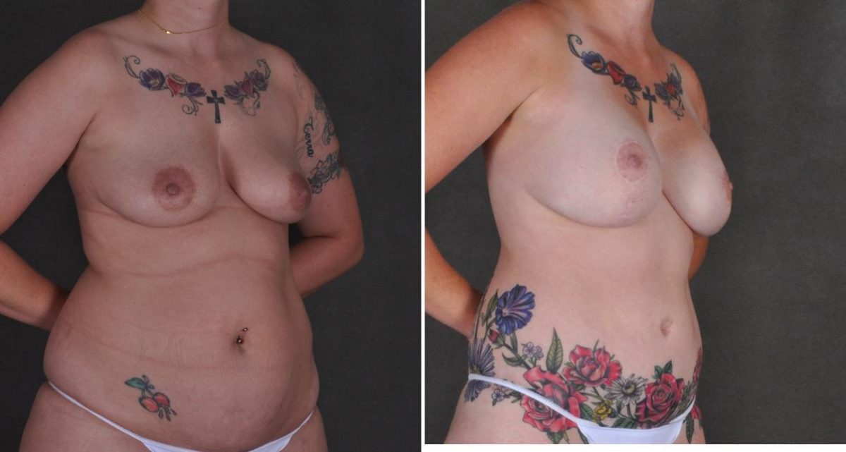 Breast Lift Before and After Photos in Omaha, NE, Case 10456