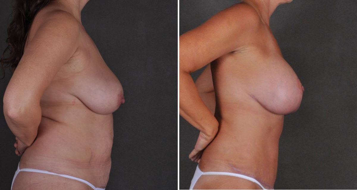 Breast Lift Before and After Photos in Omaha, NE, Case 10513