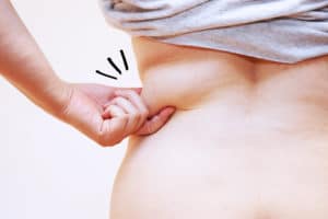 Does fat come back after liposuction?