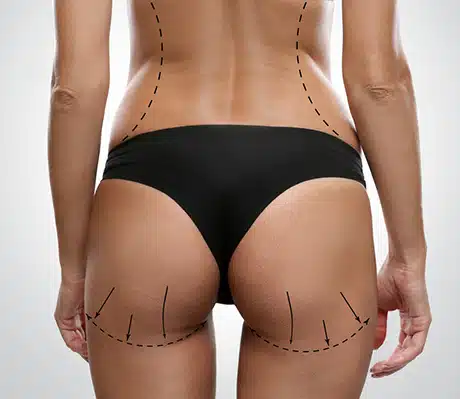 Brazilian Butt Lift post-operative care