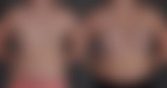Breast Augmentation Before and After Photos in Omaha, NE, Case 10275