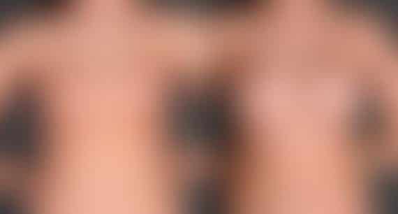 Breast Augmentation Before and After Photos in Omaha, NE, Case 4690