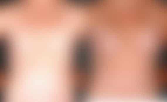 Breast Augmentation Before and After Photos in Omaha, NE, Case 4697