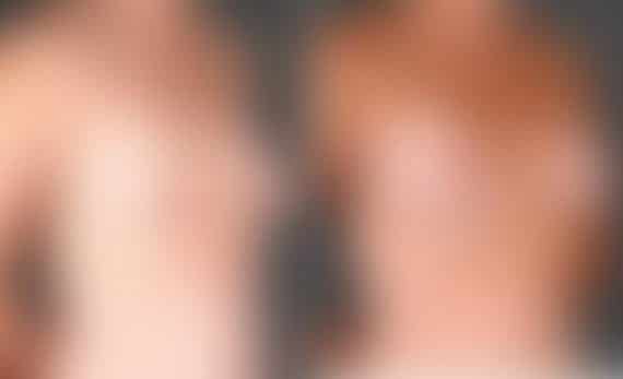 Breast Augmentation Before and After Photos in Omaha, NE, Case 4697