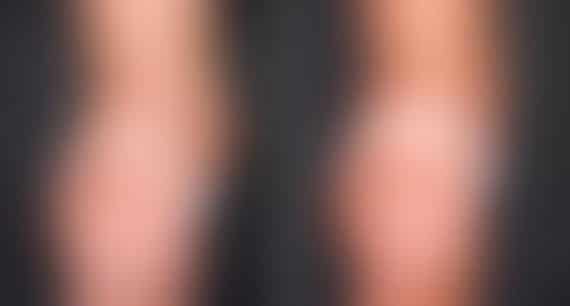 Breast Augmentation Before and After Photos in Omaha, NE, Case 4719