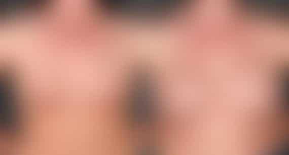 Breast Augmentation Before and After Photos in Omaha, NE, Case 4764
