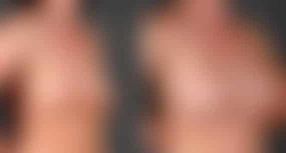 Breast Augmentation Before and After Photos in Omaha, NE, Case 4764