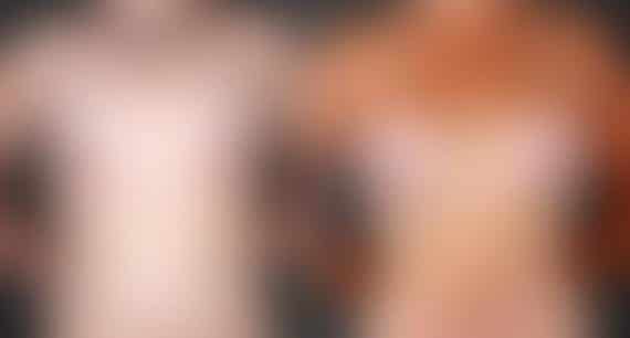 Breast Augmentation Before and After Photos in Omaha, NE, Case 4805