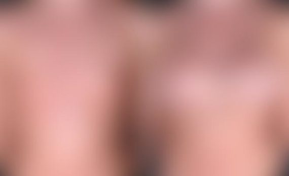 Breast Augmentation Before and After Photos in Omaha, NE, Case 4849