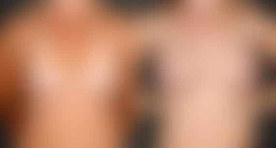 Breast Augmentation Before and After Photos in Omaha, NE, Case 4873
