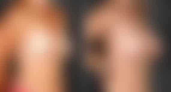 Breast Augmentation Before and After Photos in Omaha, NE, Case 4873