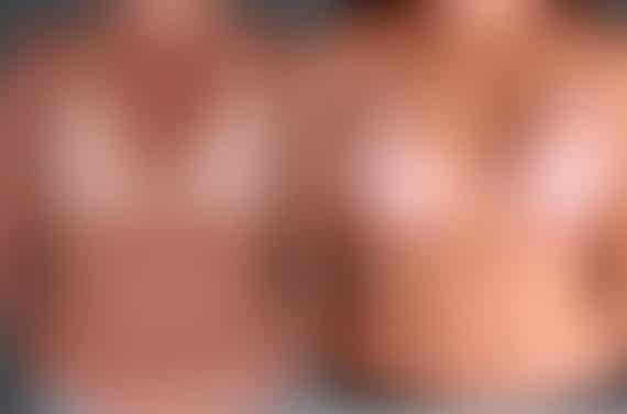 Breast Augmentation Before and After Photos in Omaha, NE, Case 4904