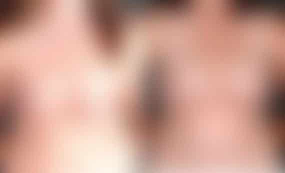 Breast Augmentation Before and After Photos in Omaha, NE, Case 4959