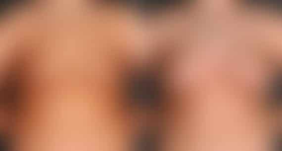 Breast Augmentation Before and After Photos in Omaha, NE, Case 4984