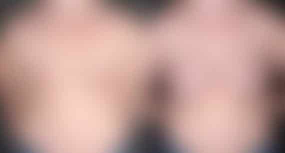 Breast Augmentation Before and After Photos in Omaha, NE, Case 5013