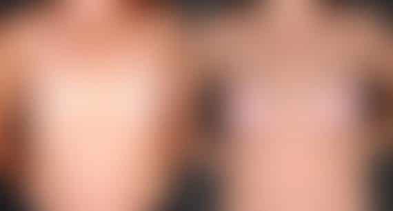 Breast Augmentation Before and After Photos in Omaha, NE, Case 5049