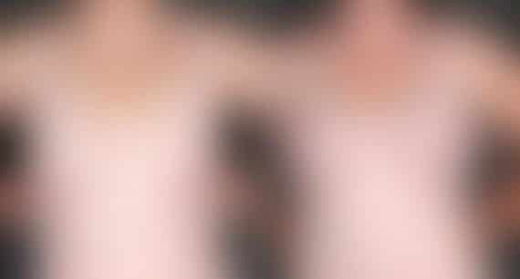 Breast Augmentation Before and After Photos in Omaha, NE, Case 5075