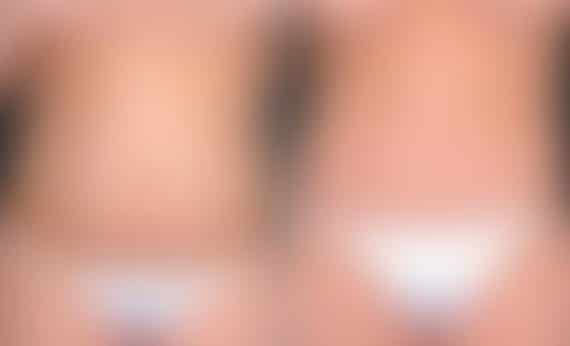 Breast Augmentation Before and After Photos in Omaha, NE, Case 5097
