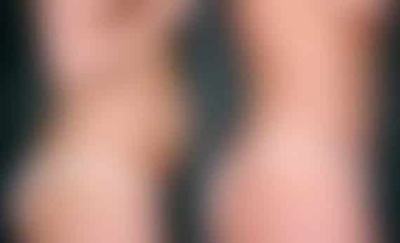 Breast Augmentation Before and After Photos in Omaha, NE, Case 5097