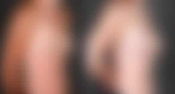 Breast Augmentation Before and After Photos in Omaha, NE, Case 5111