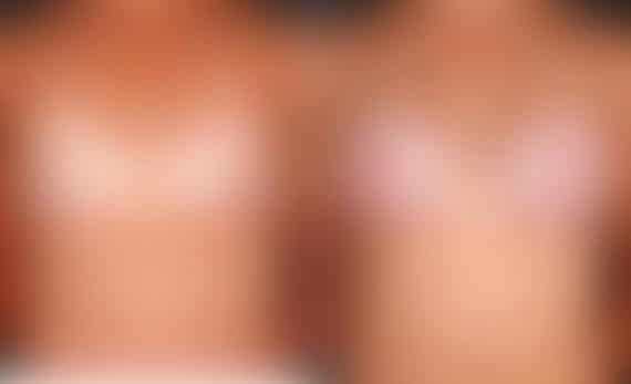 Breast Augmentation Before and After Photos in Omaha, NE, Case 5147