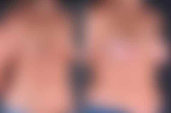 Breast Augmentation Before and After Photos in Omaha, NE, Case 5166
