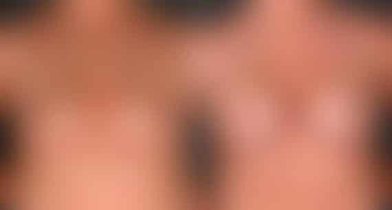 Breast Augmentation Before and After Photos in Omaha, NE, Case 5201